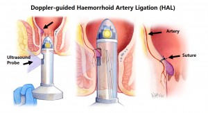 doppler-guided-haemorrhoid-artery-ligation_e
