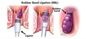 rubber-band-ligation-for-haemorrhoids_e