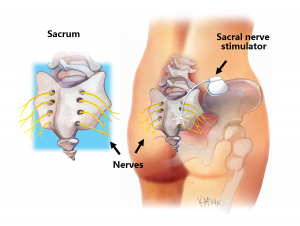 sacral-nerve-stimulation_e
